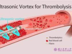 Peneliti NTHU kembangkan perangkat trombolitik pusaran ultrasonik